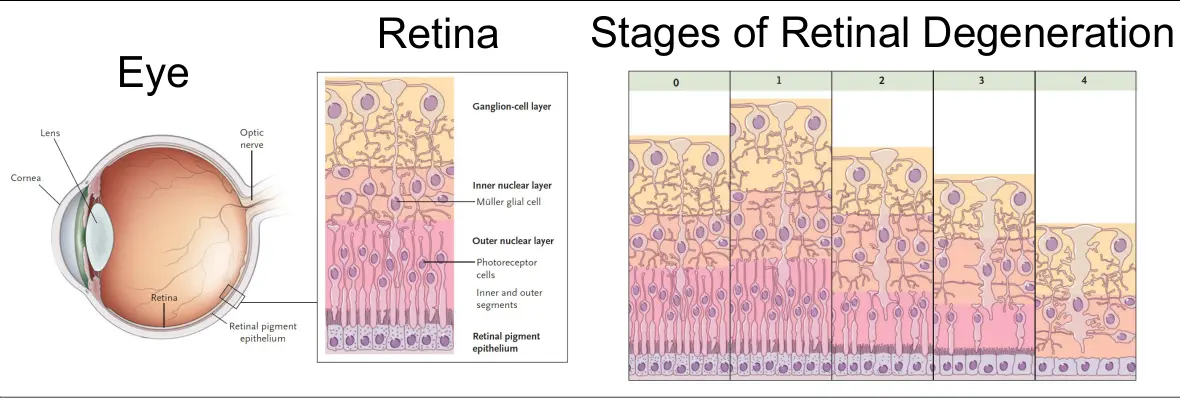 Eye, retina and stages of retinal degeneration